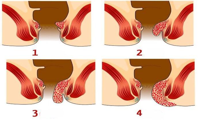 wie Hämorrhoiden in verschiedenen Stadien aussehen